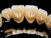 Kerámia fogpótlások 009 Kerámia fogpótlások 009