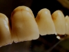 Kerámia fogpótlások 014 Kerámia fogpótlások 014