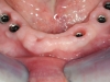Alsó implantátumos körhíd 1 Alsó implantátumos körhíd 1