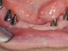 Alsó implantátumos körhíd 2 Alsó implantátumos körhíd 2